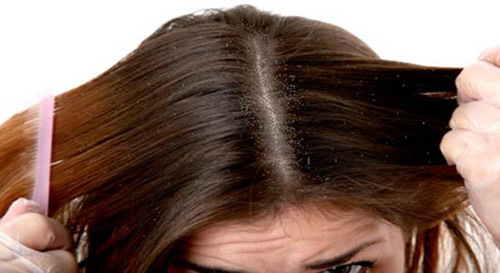علاج قشرة الشعر الجاف طبيعيا طريقة