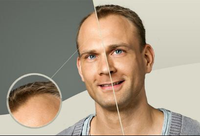 تجربتي مع زراعة الشعر