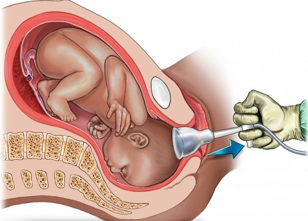 مخاطر شفط رأس الجنين أثناء الولادة